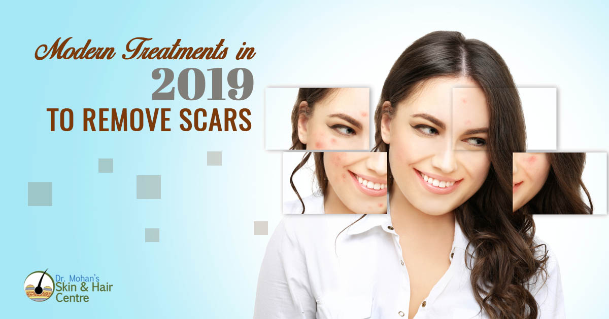 Modern Treatmens in 2019 to remove scars