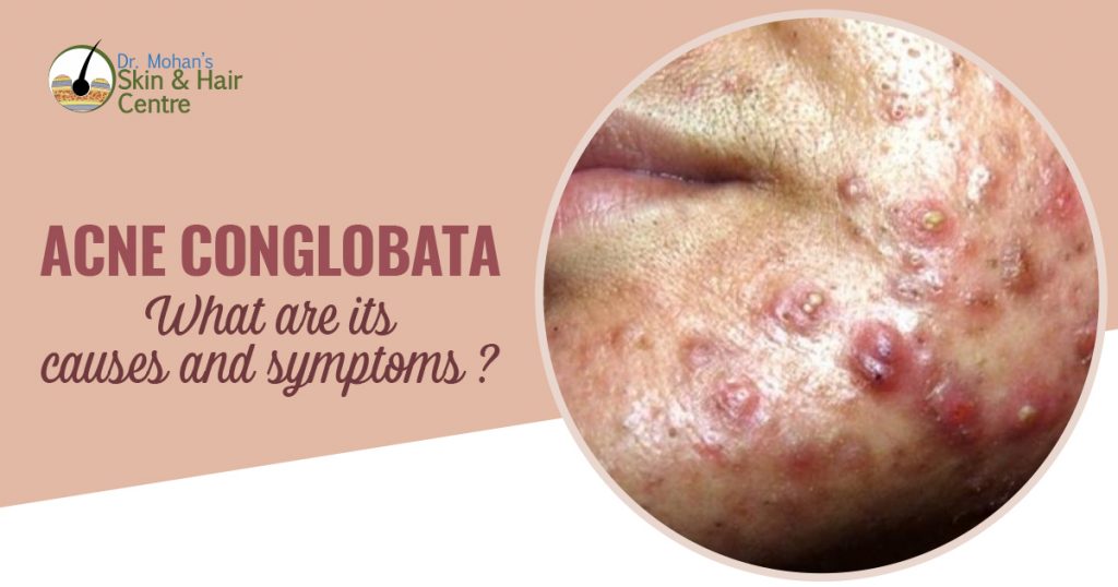 Acne Conglobata - What are its causes and symptoms