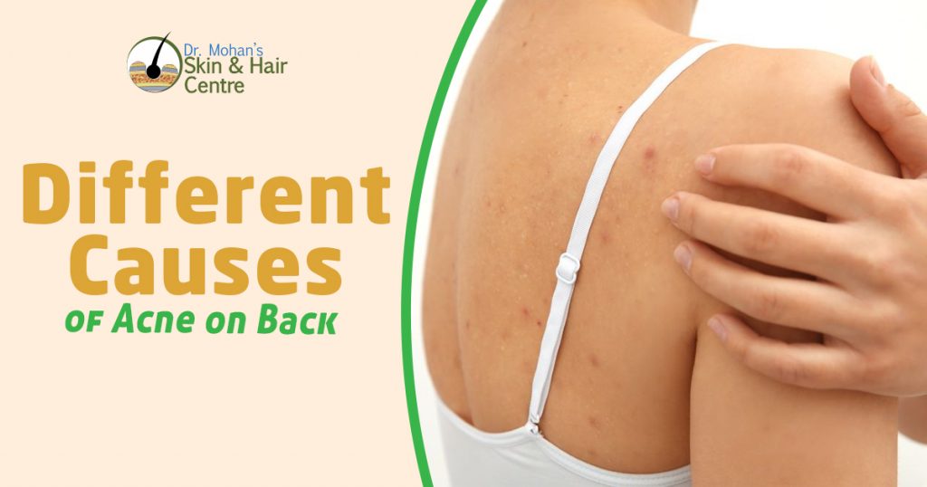 Different Causes of Acne on Back