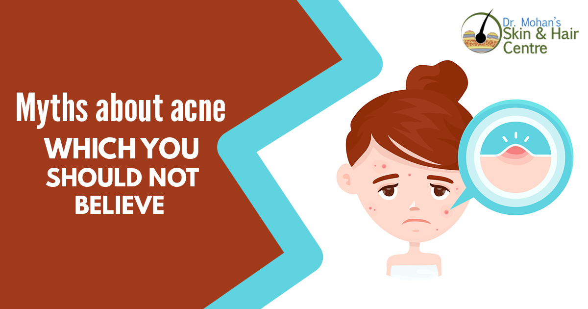 Myths about acne which you should not believe