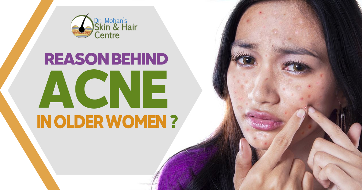 Reason Behind Acne In Older Women