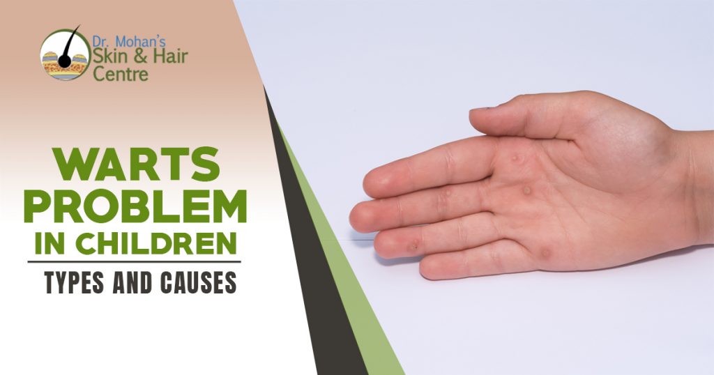 Warts Problem in Children - Types and causes