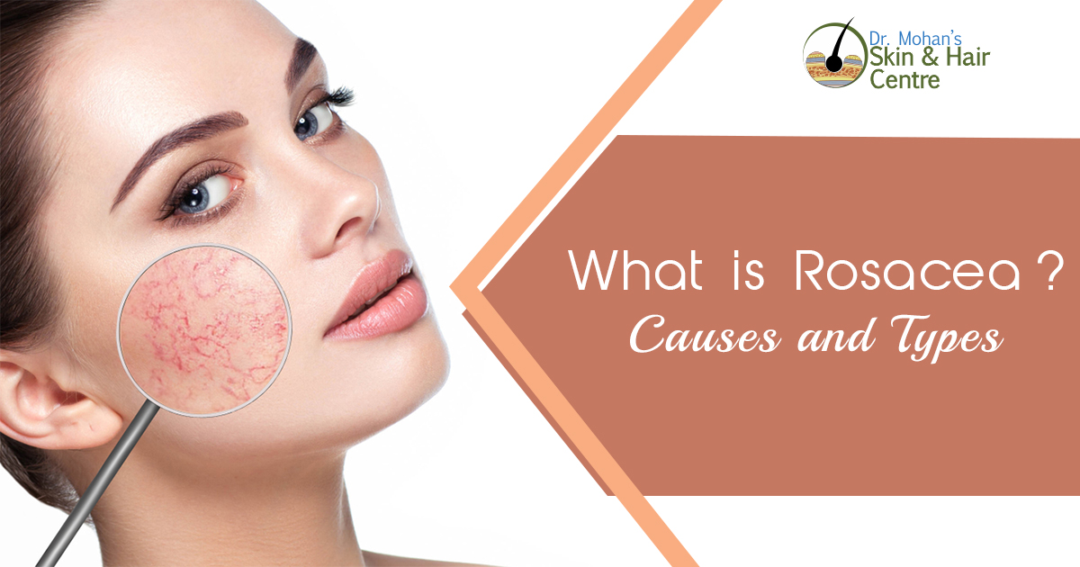 What is Rosacea - Causes and Types