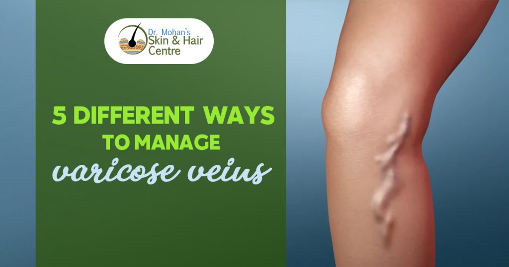 5 Different ways to manage varicose veins