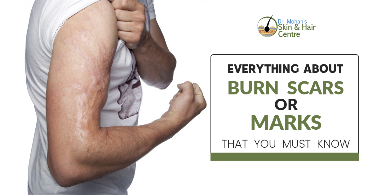 Everything About Burn Scars or Marks that you must know