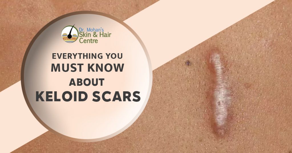 Everything You must know about keloid scars
