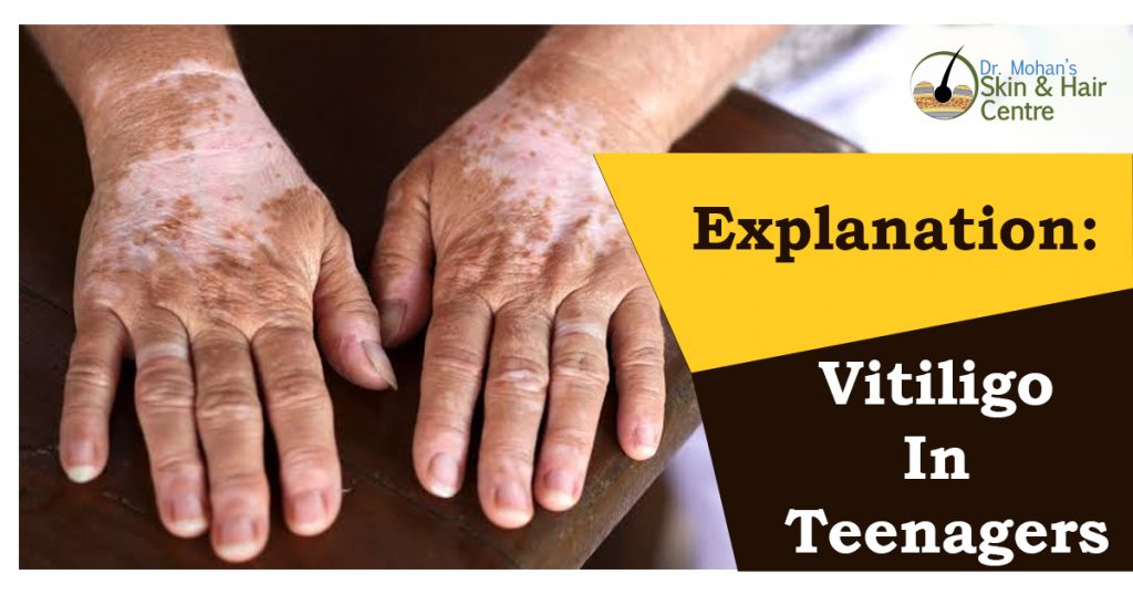 Explanation Vitiligo In Teenagers