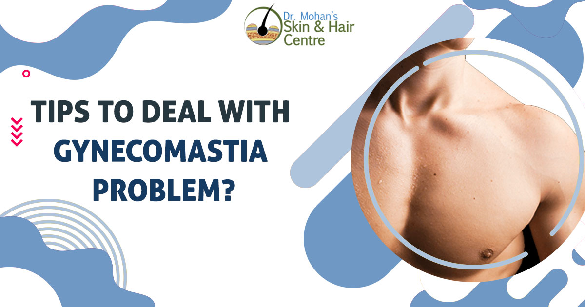 Tips to deal with gynecomastia problem