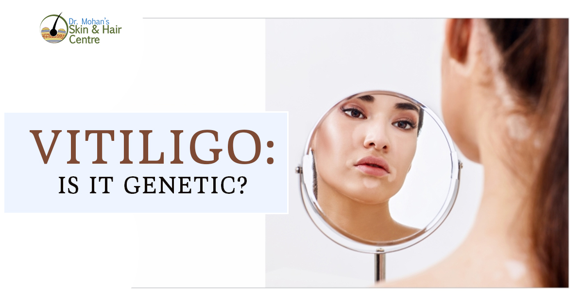 Vitiligo is it genetic