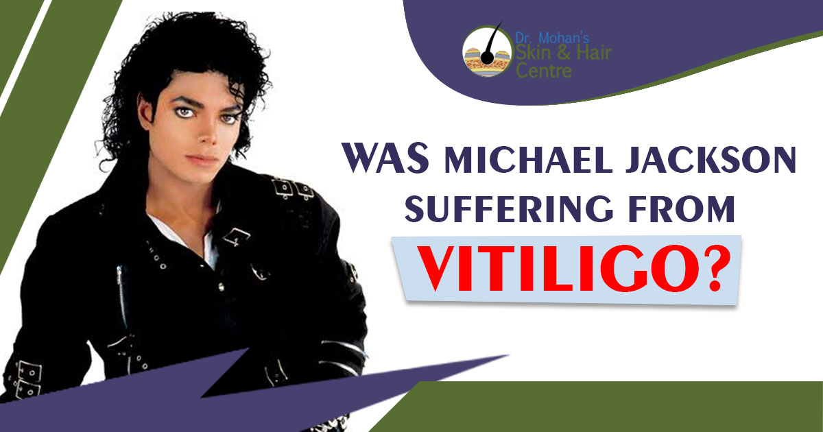 Was Michael Jackson Suffering From Vitiligo