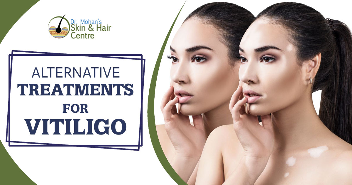 Alternative Treatments for Vitiligo