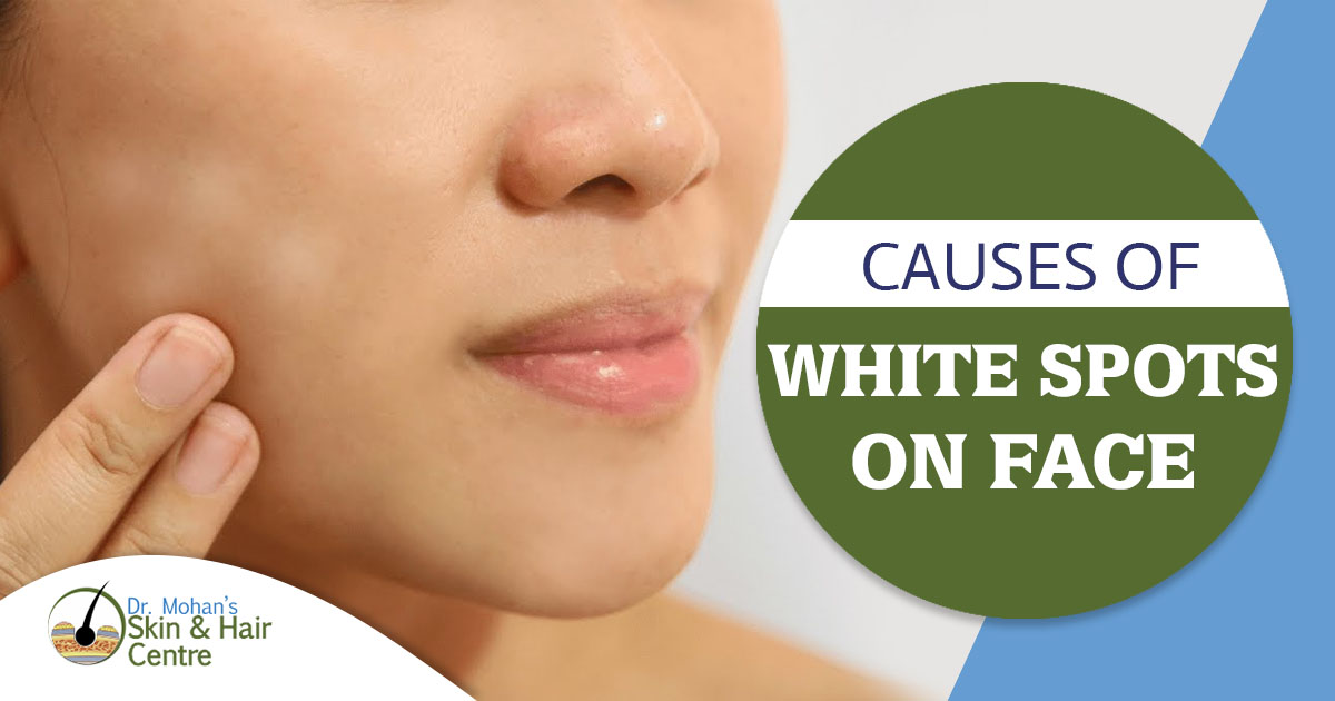 Causes of white spots on face