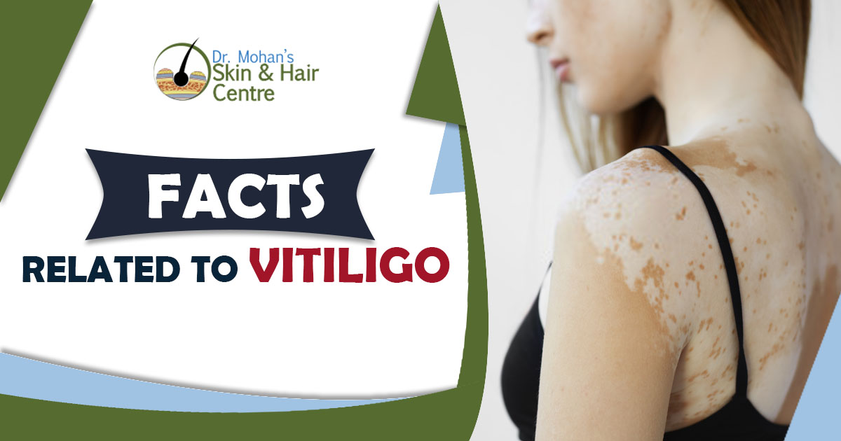 Facts Related to Vitiligo
