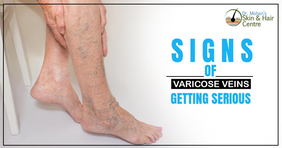 Signs of Varicose Veins Getting Serious
