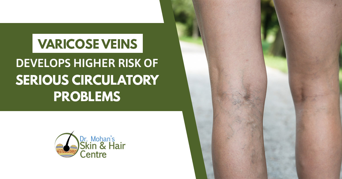 Varicose Veins Develops Higher Risk of Serious Circulatory Problems