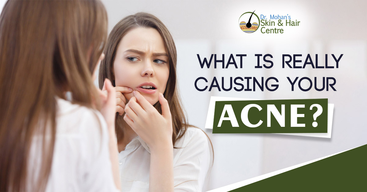 What is really causing your Acne