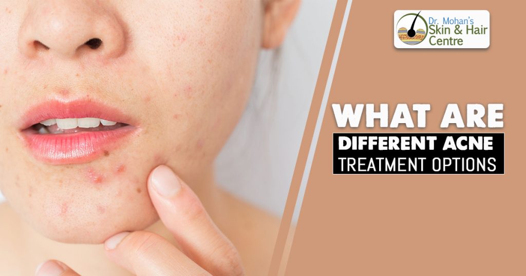 What are different acne treatment options