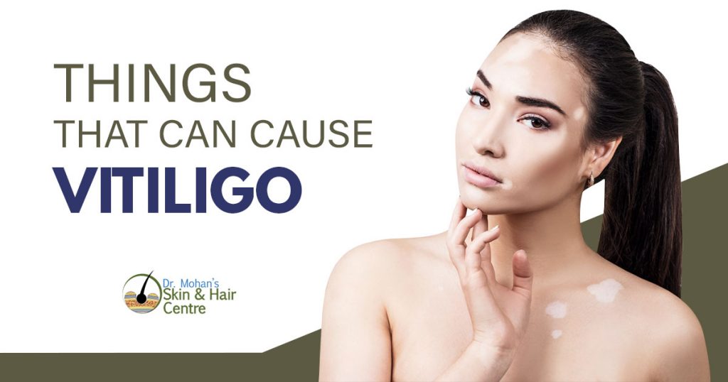 Things that can cause vitiligo