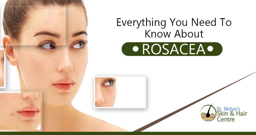 Everything you need to know about rosacea