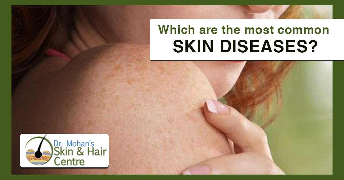 Which are the most common skin diseases
