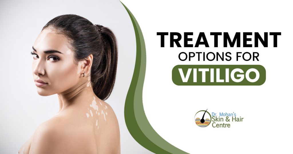 Treatment options for Vitiligo