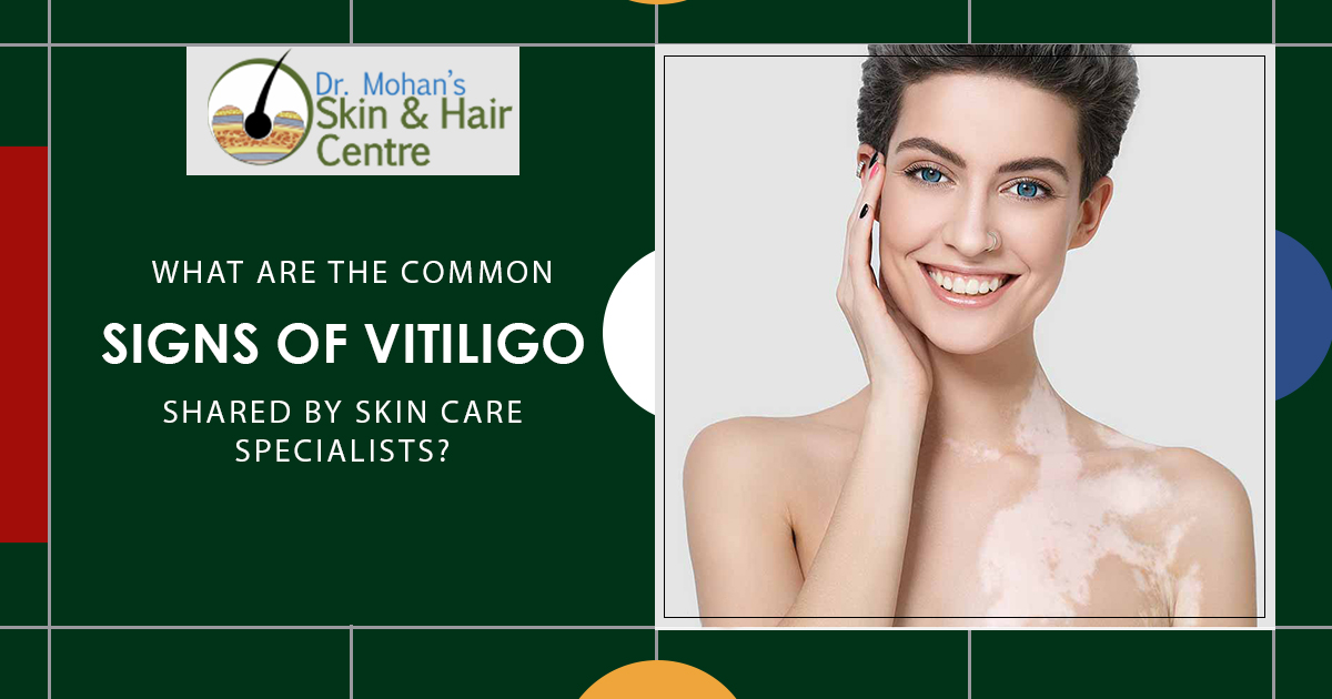 signs of Vitiligo shared by skin care specialists